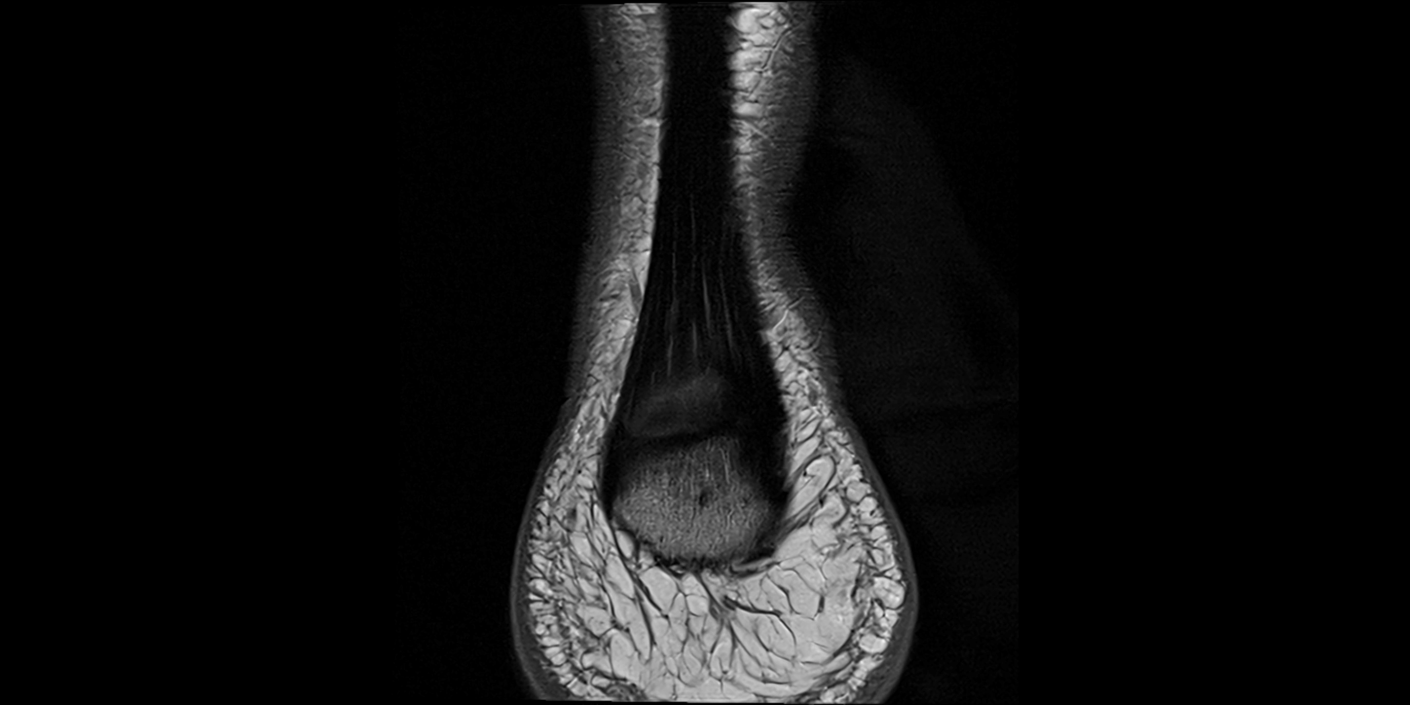 MRI Ankle coronal ligaments cross sectional anatomy 3T  radiology  image-img-00001-00031.webp